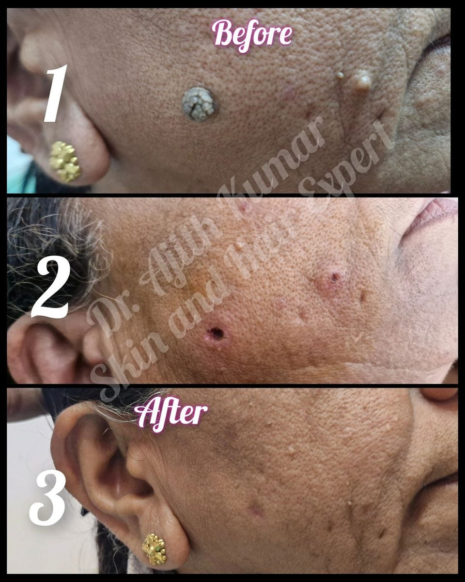Holistic Skin and Hair Expert Udupi - Acne Treatment Before and After