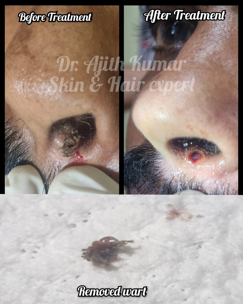 Holistic Skin & Hair Expert in Udupi - Pigmentation Removal