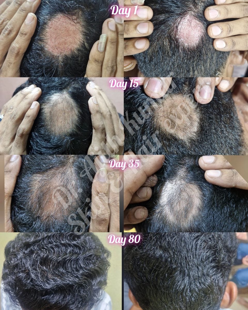Holistic Skin & Hair Expert in Udupi - Patient Results