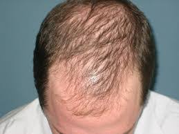 Mole Removal Udupi